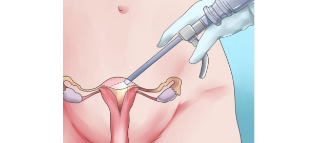 Выскабливание полости матки (гинекология) — чистка