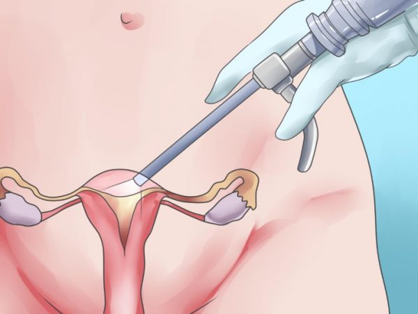 Выскабливание полости матки (гинекология) — чистка